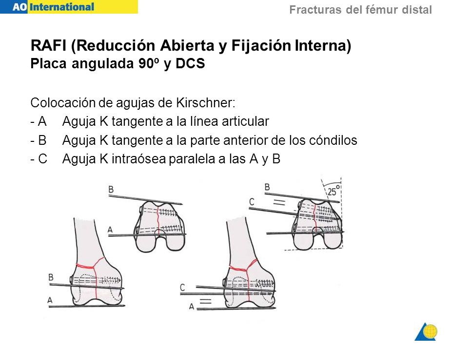 RAFI (Reducción Abierta y Fijación Interna) Placa angulada 90º y DCS