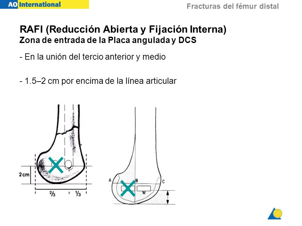 RAFI (Reducción Abierta y Fijación Interna) Zona de entrada de la Placa angulada y DCS