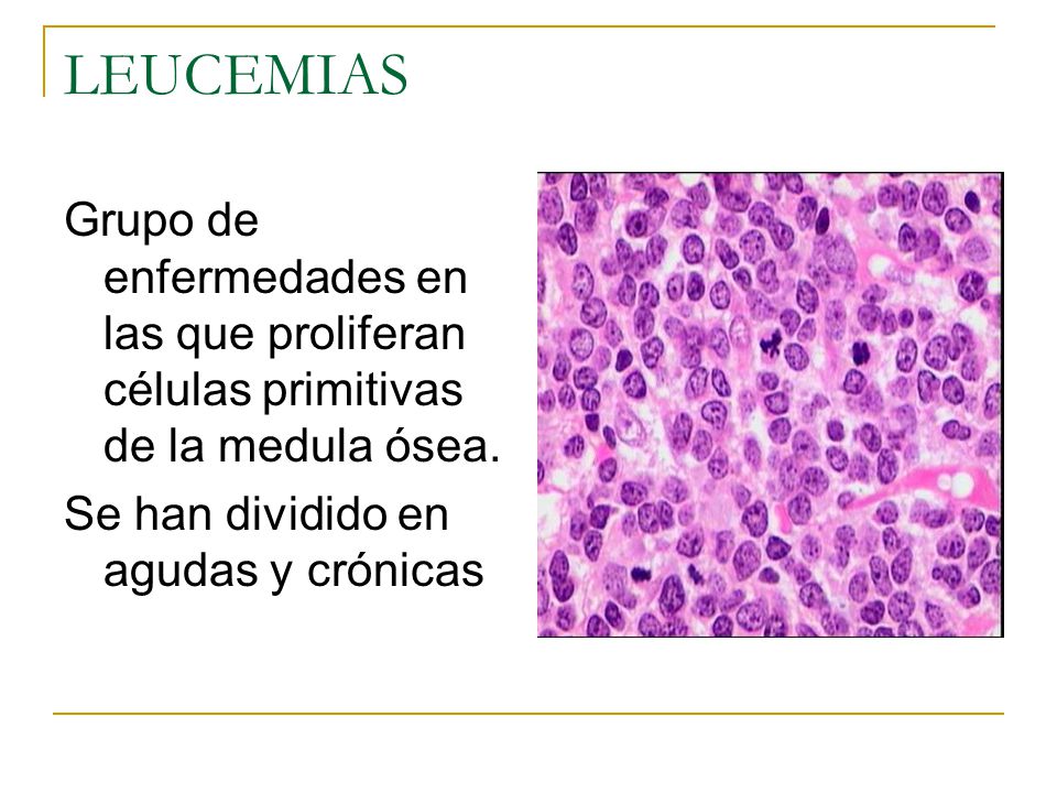 LEUCEMIAS Grupo de enfermedades en las que proliferan células primitivas de la medula ósea.