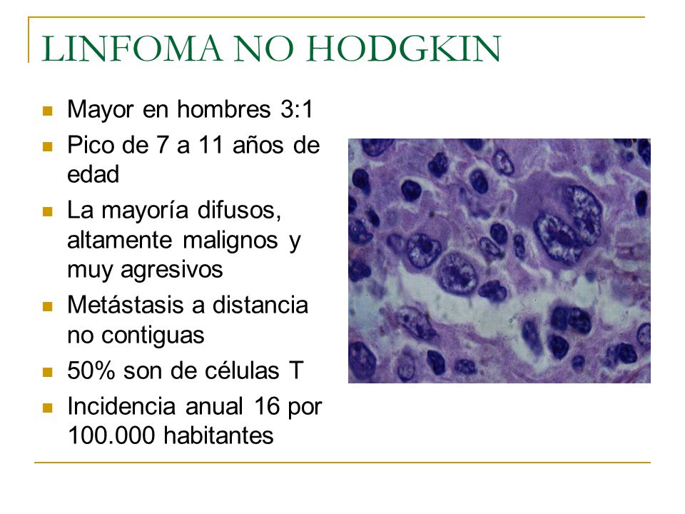 LINFOMA NO HODGKIN Mayor en hombres 3:1 Pico de 7 a 11 años de edad