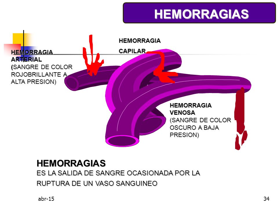 HEMORRAGIAS HEMORRAGIAS ES LA SALIDA DE SANGRE OCASIONADA POR LA