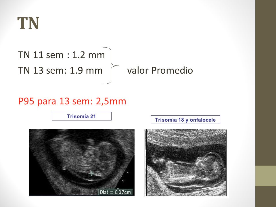 TN TN 11 sem : 1.2 mm TN 13 sem: 1.9 mm valor Promedio