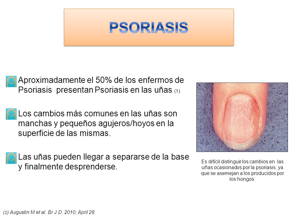 PSORIASIS Aproximadamente el 50% de los enfermos de Psoriasis presentan Psoriasis en las uñas (1)