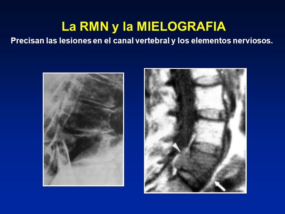 La RMN y la MIELOGRAFIA Precisan las lesiones en el canal vertebral y los elementos nerviosos.
