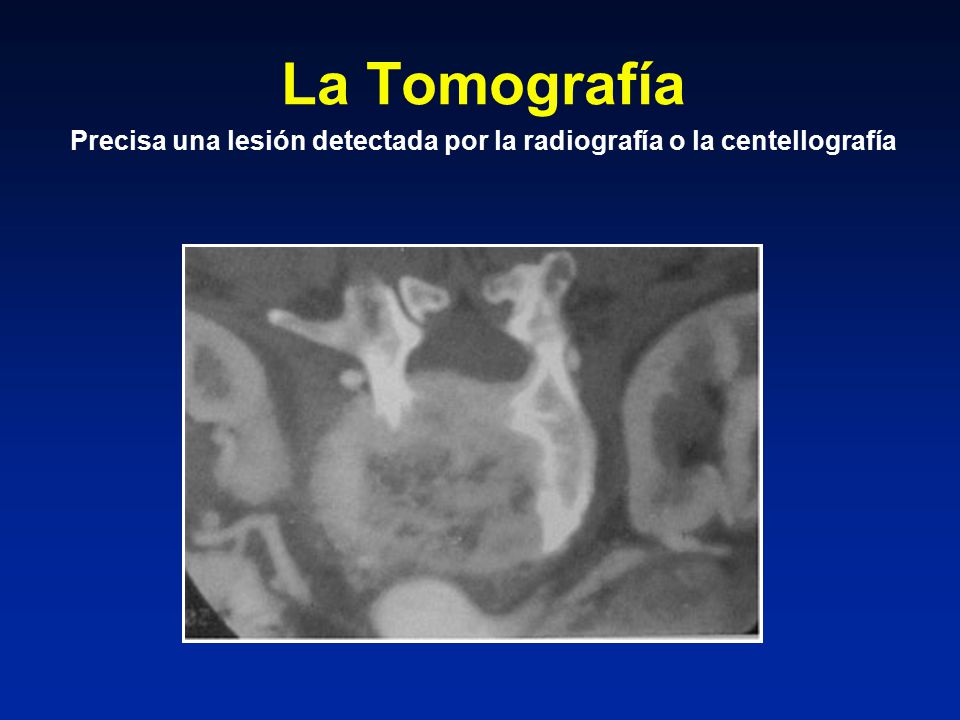 Precisa una lesión detectada por la radiografía o la centellografía