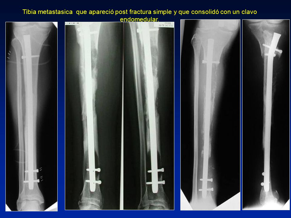 Tibia metastasica que apareció post fractura simple y que consolidó con un clavo endomedular.