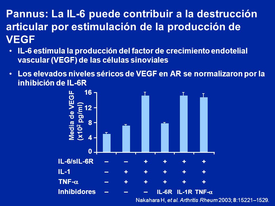 Pannus: La IL-6 puede contribuir a la destrucción articular por estimulación de la producción de VEGF