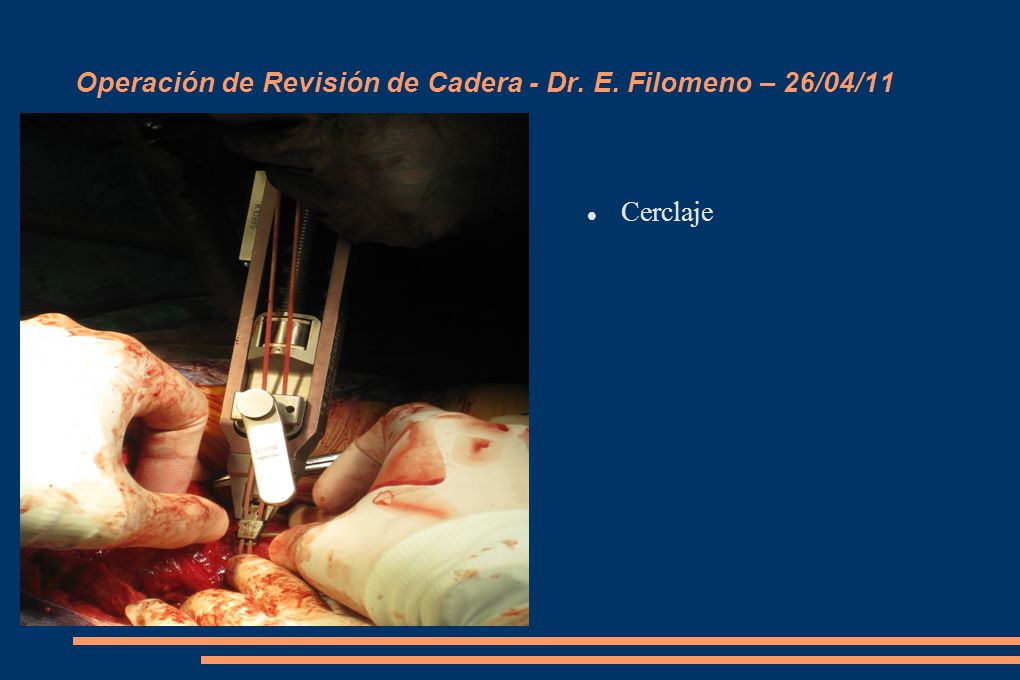Operación de Revisión de Cadera - Dr. E. Filomeno – 26/04/11