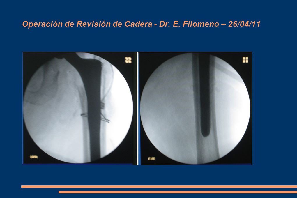Operación de Revisión de Cadera - Dr. E. Filomeno – 26/04/11
