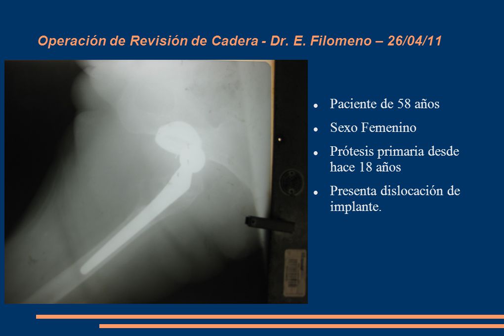 Operación de Revisión de Cadera - Dr. E. Filomeno – 26/04/11
