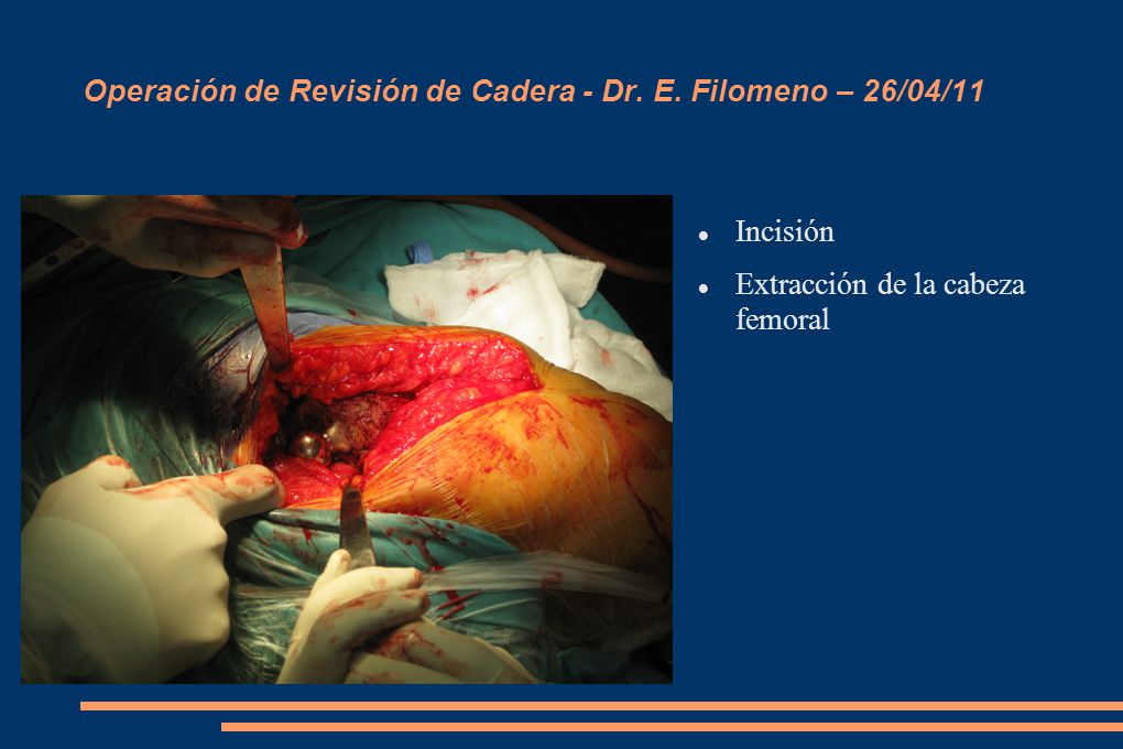 Operación de Revisión de Cadera - Dr. E. Filomeno – 26/04/11