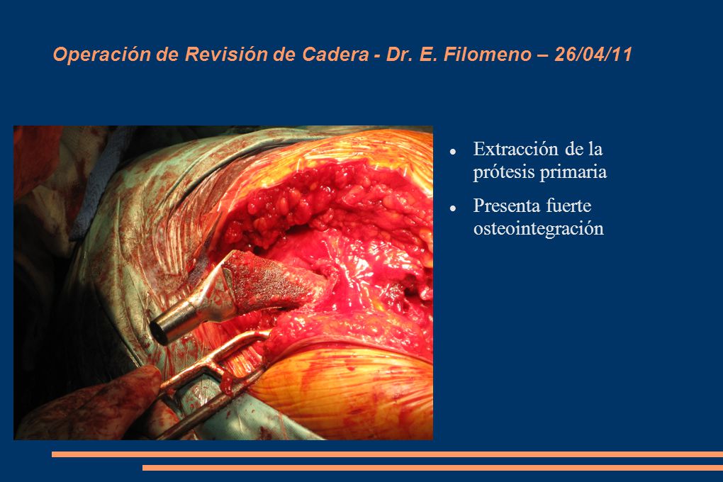 Operación de Revisión de Cadera - Dr. E. Filomeno – 26/04/11