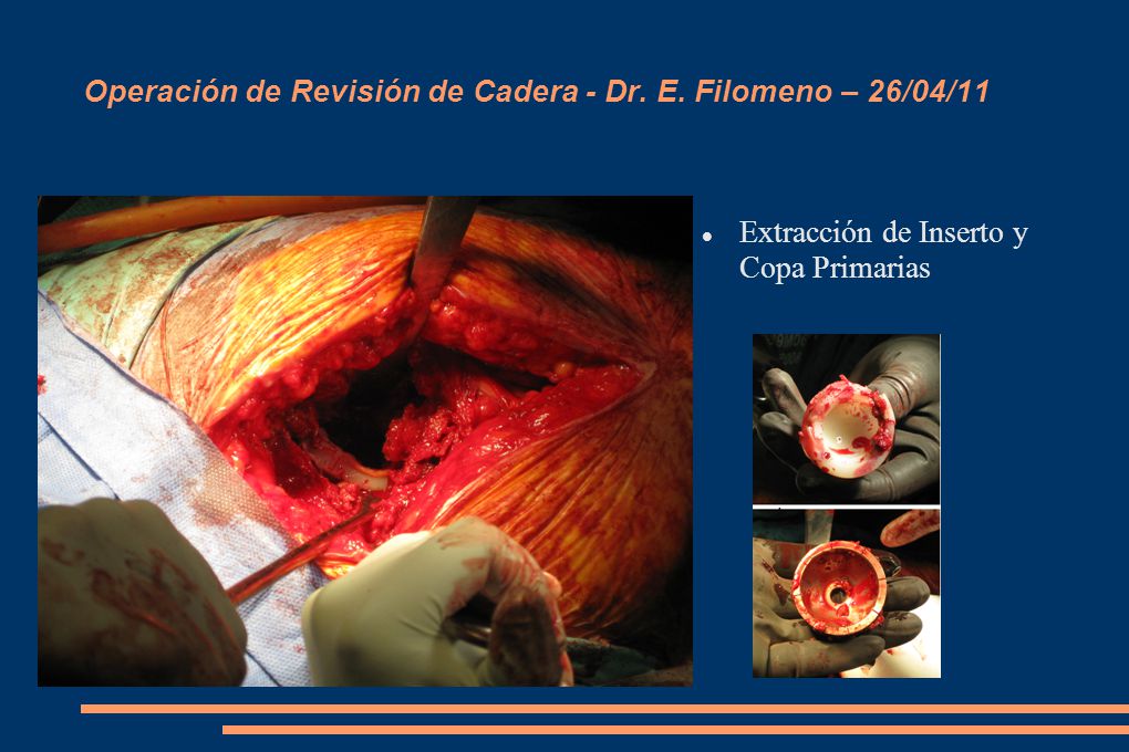 Operación de Revisión de Cadera - Dr. E. Filomeno – 26/04/11