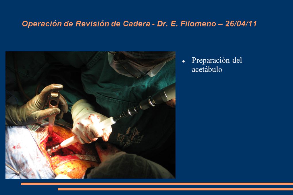 Operación de Revisión de Cadera - Dr. E. Filomeno – 26/04/11