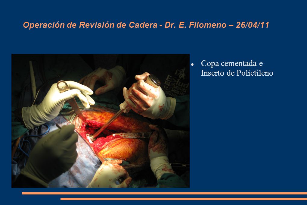 Operación de Revisión de Cadera - Dr. E. Filomeno – 26/04/11