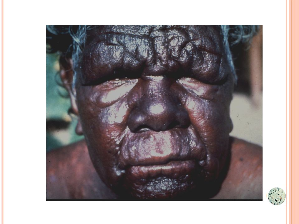 Si no tratamiento: fascies leonina, que puede dar lugar a la pérdida de las cejas (madarosis), perforación septal, caida de dientes, úlceras en manos, piernas, deformidad por neuropatía periférica, etc.