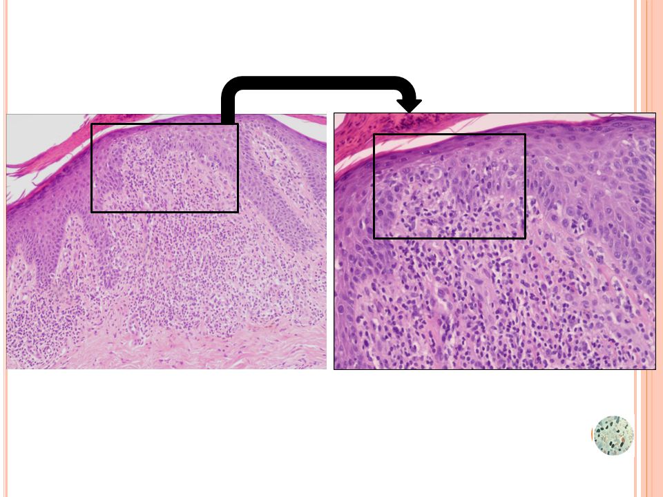 DERMATITIS CRÓNICA PSORIASIFORME, TIPO LIQUEN NITIDO (10B2817)