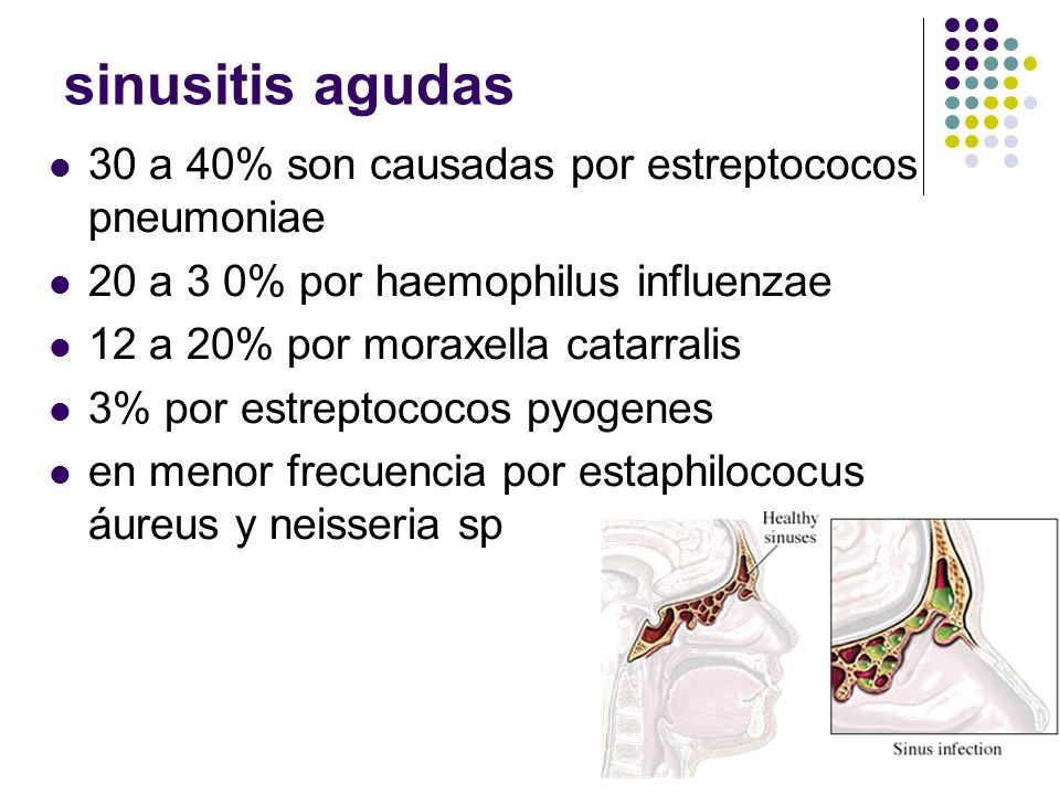 sinusitis agudas 30 a 40% son causadas por estreptococos pneumoniae