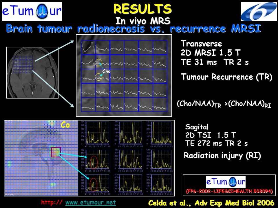 RESULTS Brain tumour radionecrosis vs. recurrence MRSI In vivo MRS