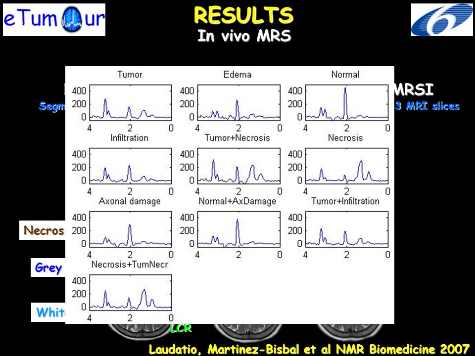 RESULTS In vivo MRS. Nosologic Image of Brain Tumour: MRI + MRSI Segmentation (MRI) + Classification (MRSI) by 4 model tissue using 3 MRI slices.