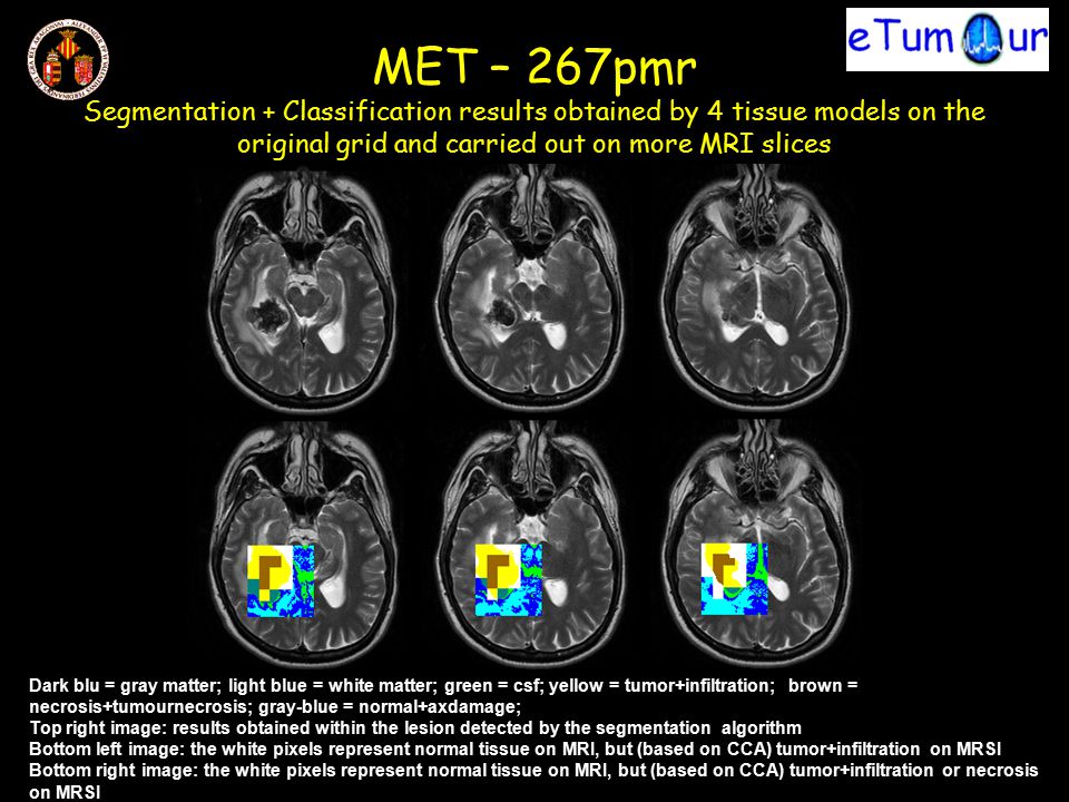 MET – 267pmr Segmentation + Classification results obtained by 4 tissue models on the original grid and carried out on more MRI slices