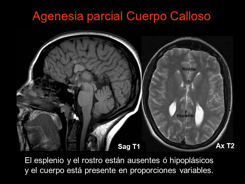 Agenesia parcial Cuerpo Calloso