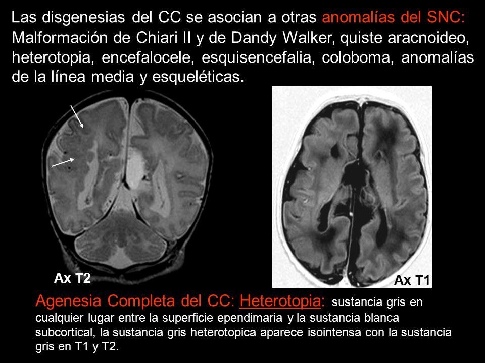 Las disgenesias del CC se asocian a otras anomalías del SNC: Malformación de Chiari II y de Dandy Walker, quiste aracnoideo, heterotopia, encefalocele, esquisencefalia, coloboma, anomalías de la línea media y esqueléticas.