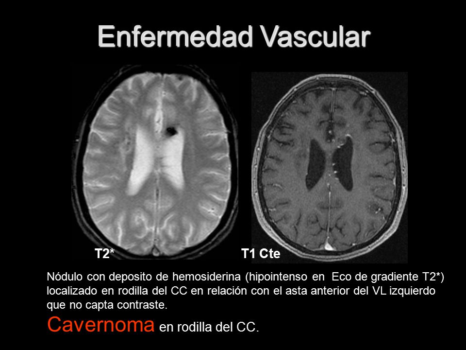 Enfermedad Vascular Cavernoma en rodilla del CC. T2* T1 Cte
