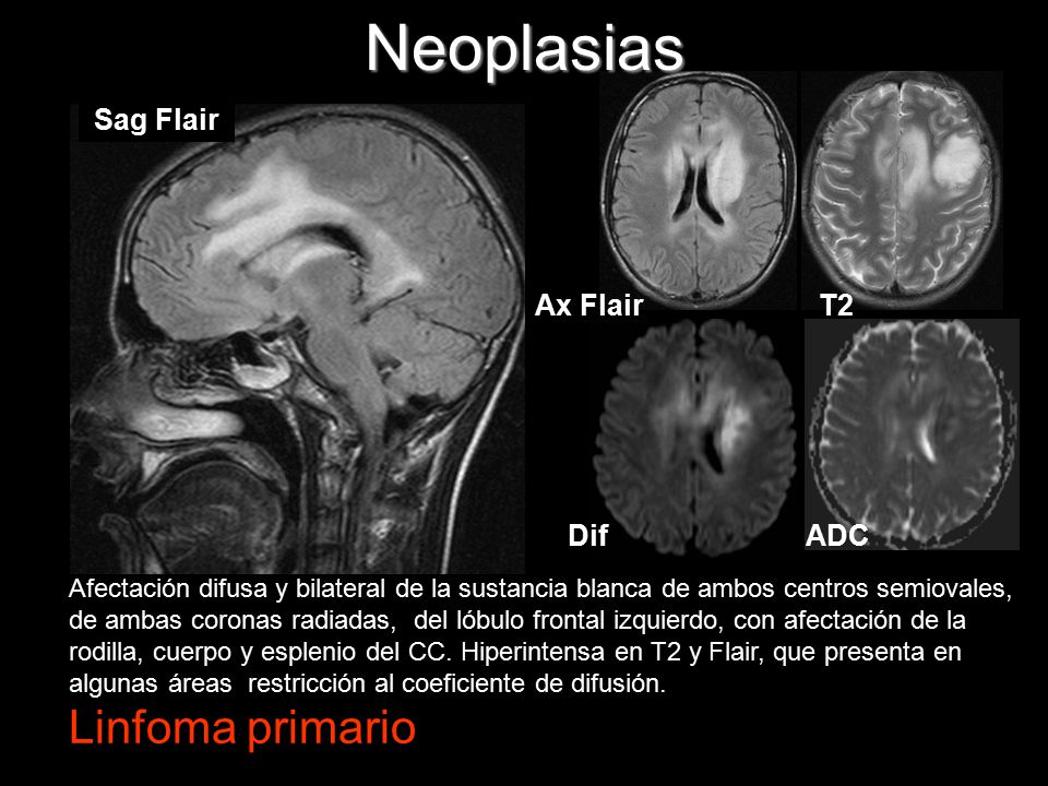 Neoplasias Linfoma primario Sag Flair Ax Flair T2 Dif ADC