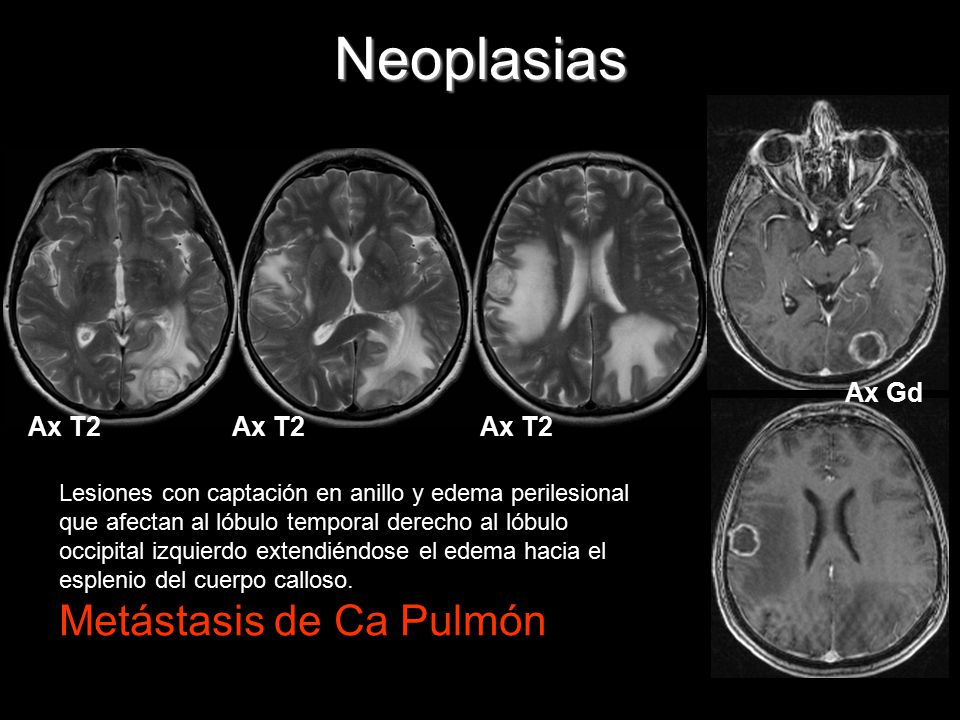 Neoplasias Metástasis de Ca Pulmón Ax Gd Ax T2 Ax T2 Ax T2