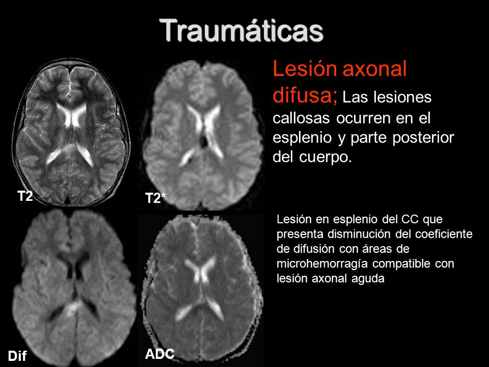 Traumáticas Lesión axonal difusa; Las lesiones callosas ocurren en el esplenio y parte posterior del cuerpo.