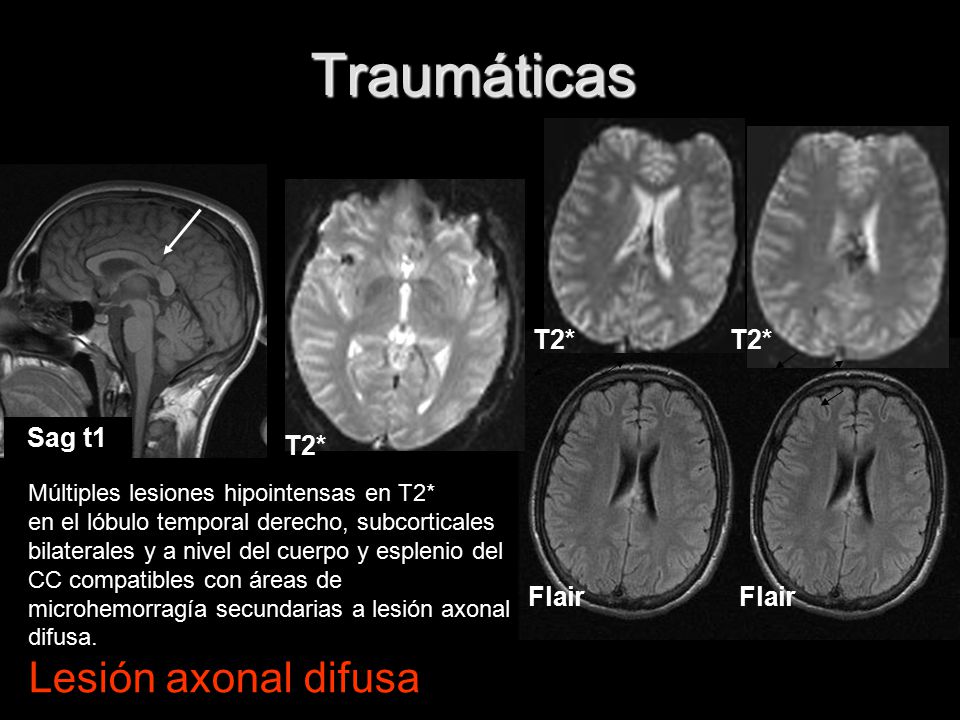 Traumáticas Lesión axonal difusa T2* T2* Sag t1 T2* Flair Flair