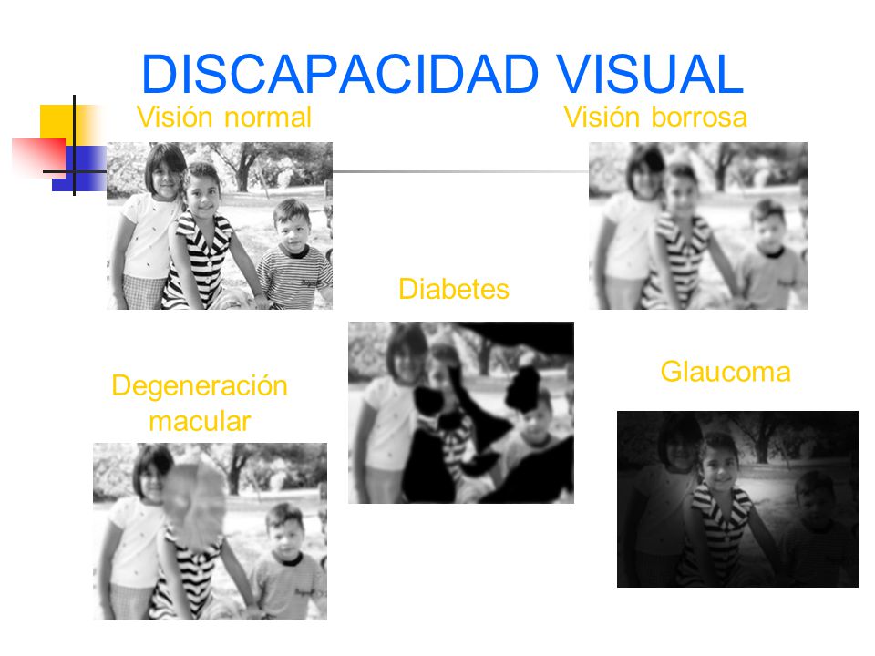 DISCAPACIDAD VISUAL Visión normal Visión borrosa Diabetes Glaucoma