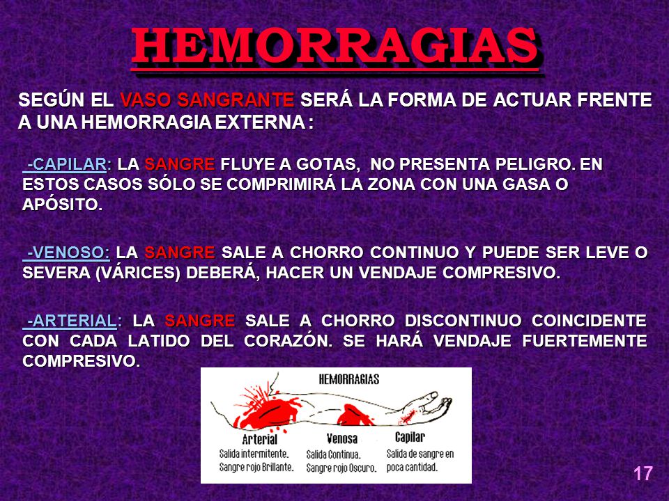 HEMORRAGIAS SEGÚN EL VASO SANGRANTE SERÁ LA FORMA DE ACTUAR FRENTE A UNA HEMORRAGIA EXTERNA :