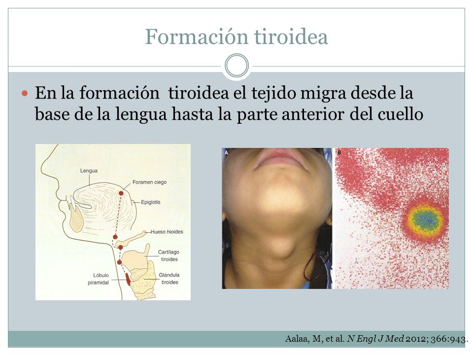 Formación tiroidea En la formación tiroidea el tejido migra desde la base de la lengua hasta la parte anterior del cuello.