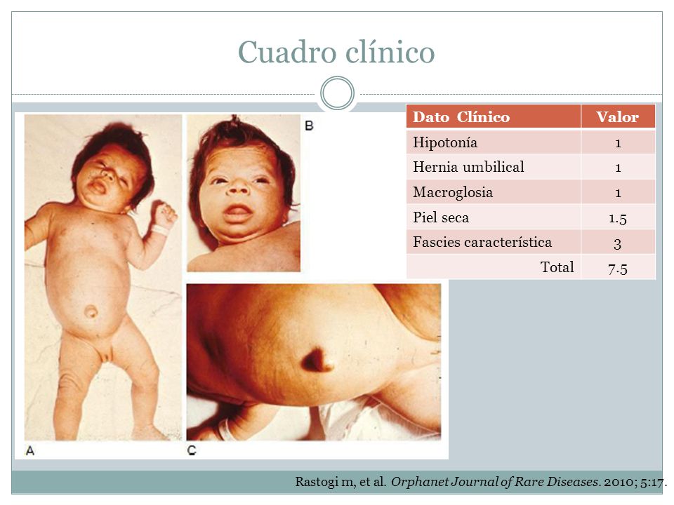 Cuadro clínico Dato Clínico Valor Hipotonía 1 Hernia umbilical