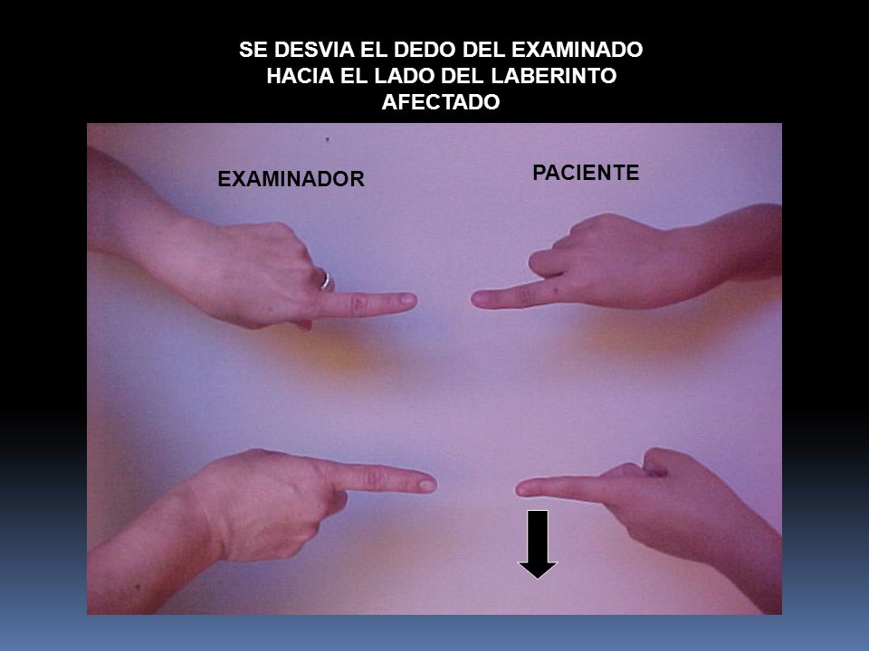 SE DESVIA EL DEDO DEL EXAMINADO HACIA EL LADO DEL LABERINTO AFECTADO