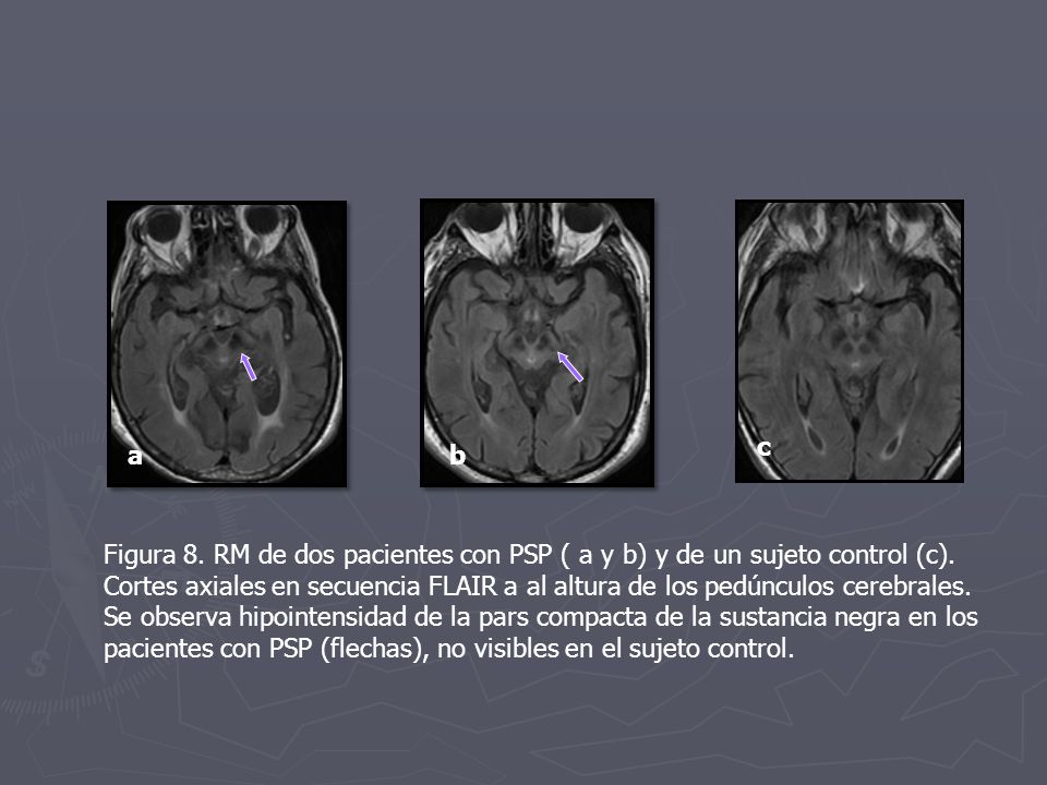 c a. b. Figura 8. RM de dos pacientes con PSP ( a y b) y de un sujeto control (c).