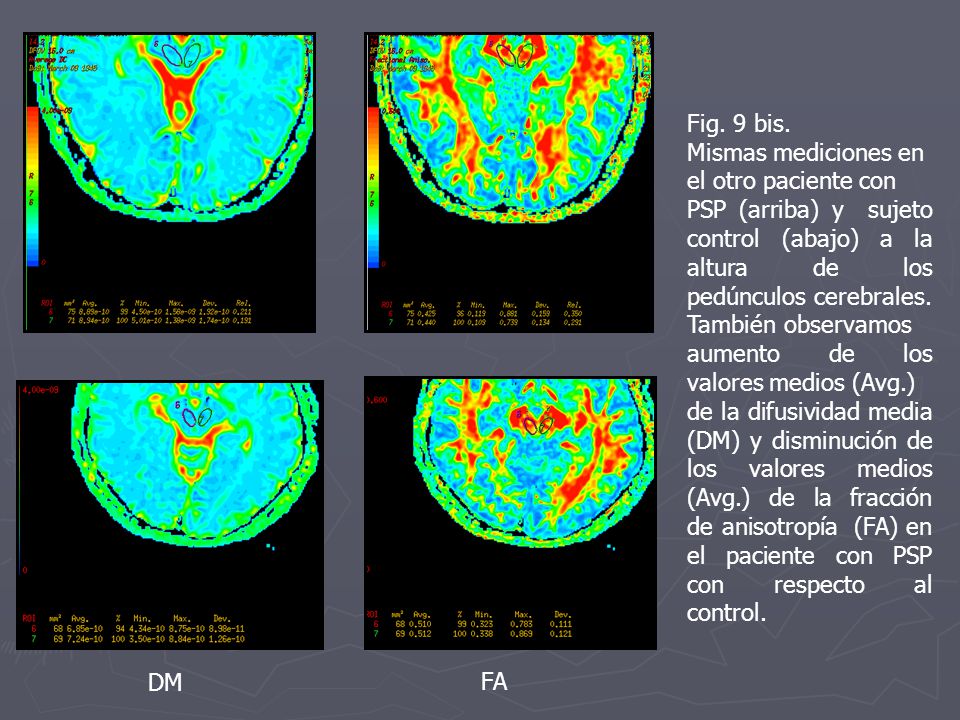 Fig. 9 bis. Mismas mediciones en. el otro paciente con. PSP (arriba) y sujeto control (abajo) a la altura de los pedúnculos cerebrales.
