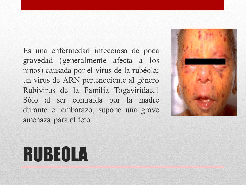 Es una enfermedad infecciosa de poca gravedad (generalmente afecta a los niños) causada por el virus de la rubéola; un virus de ARN perteneciente al género Rubivirus de la Familia Togaviridae.1 Sólo al ser contraída por la madre durante el embarazo, supone una grave amenaza para el feto