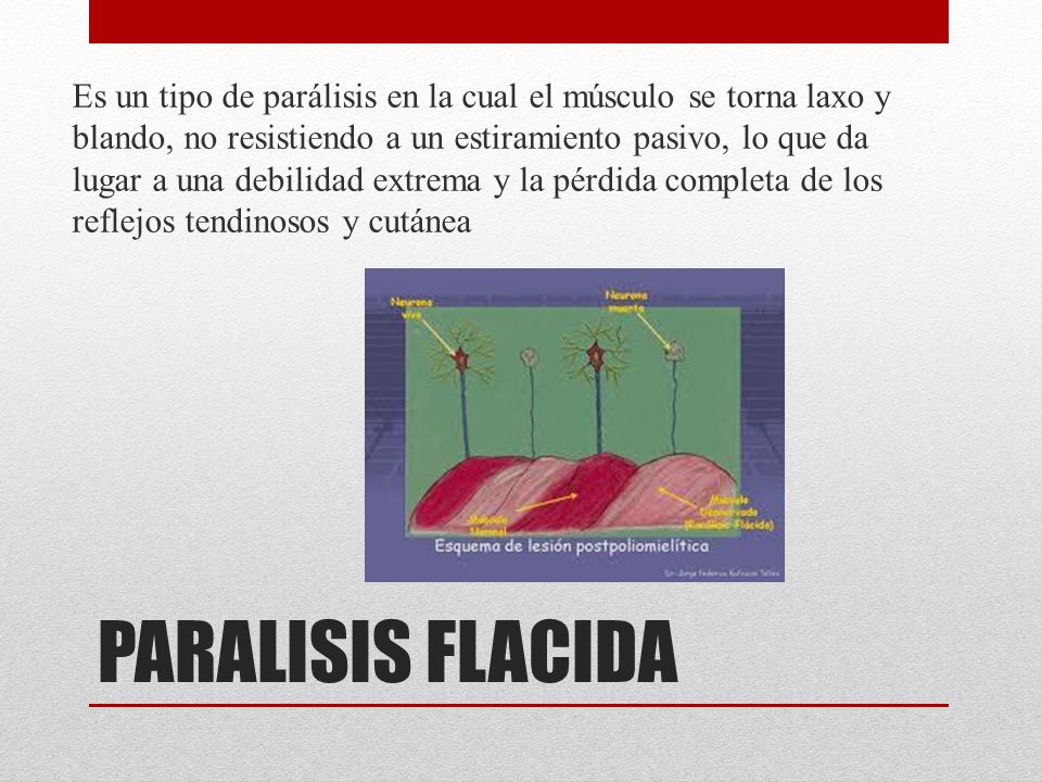 Es un tipo de parálisis en la cual el músculo se torna laxo y blando, no resistiendo a un estiramiento pasivo, lo que da lugar a una debilidad extrema y la pérdida completa de los reflejos tendinosos y cutánea