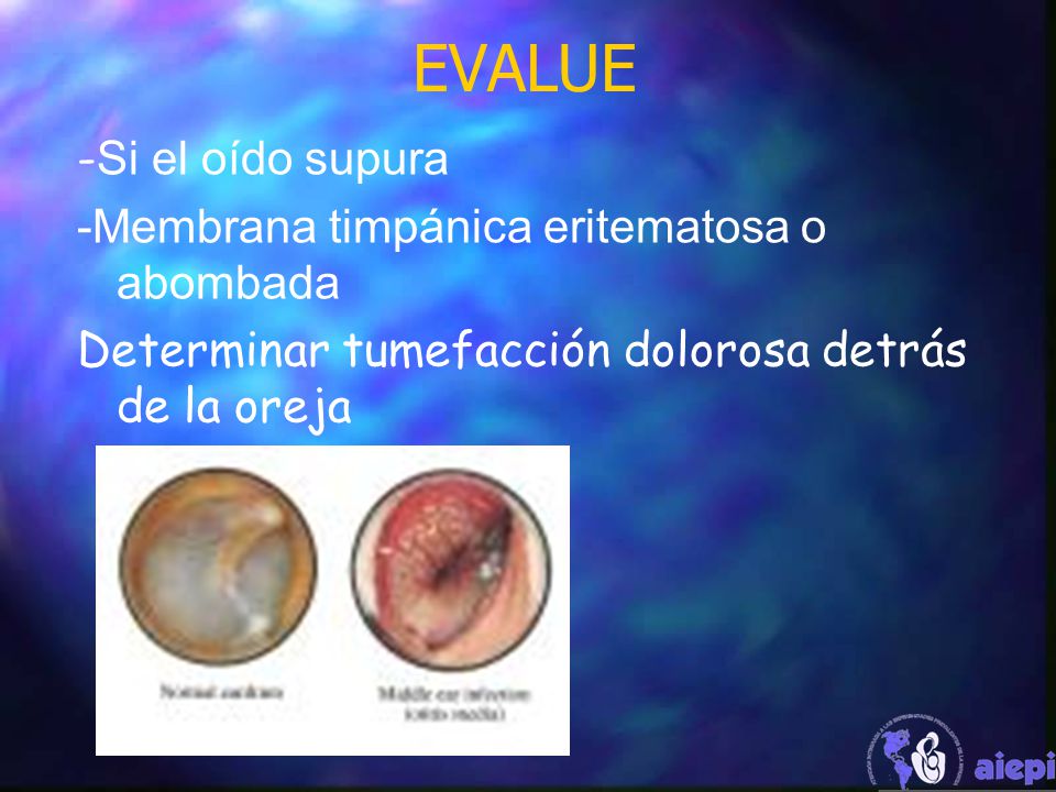 EVALUE -Si el oído supura -Membrana timpánica eritematosa o abombada