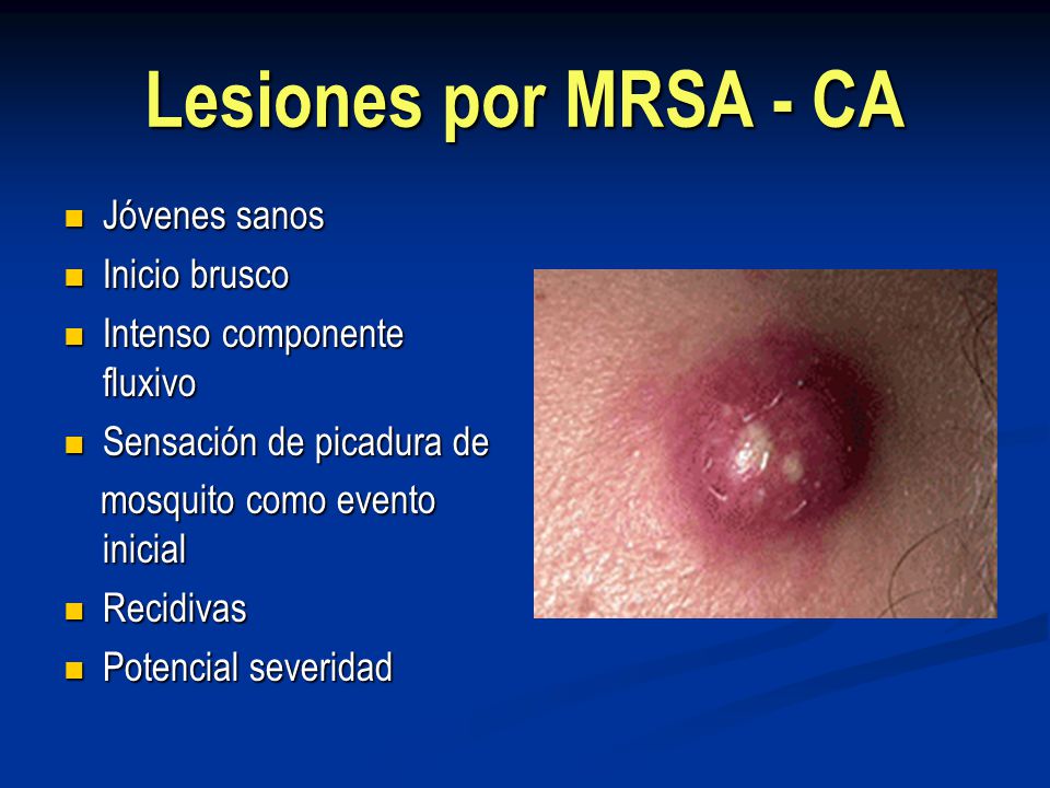 Lesiones por MRSA - CA Jóvenes sanos Inicio brusco