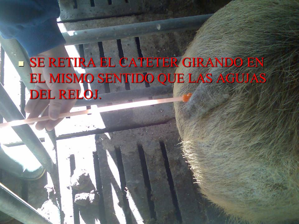 SE RETIRA EL CATETER GIRANDO EN EL MISMO SENTIDO QUE LAS AGUJAS DEL RELOJ.
