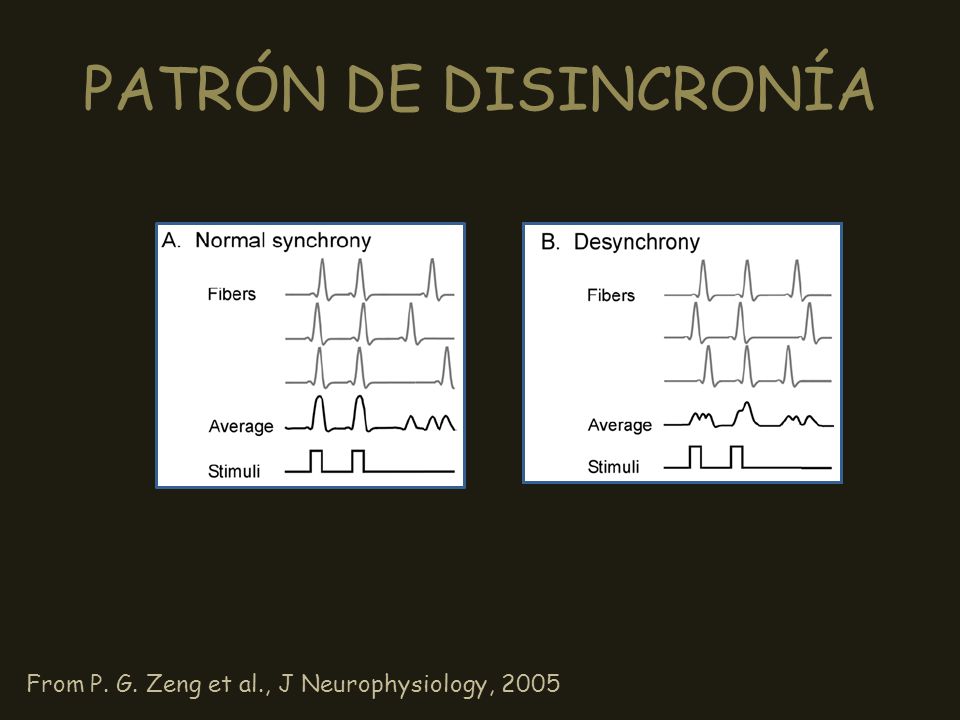PATRÓN DE DISINCRONÍA From P. G. Zeng et al., J Neurophysiology, 2005