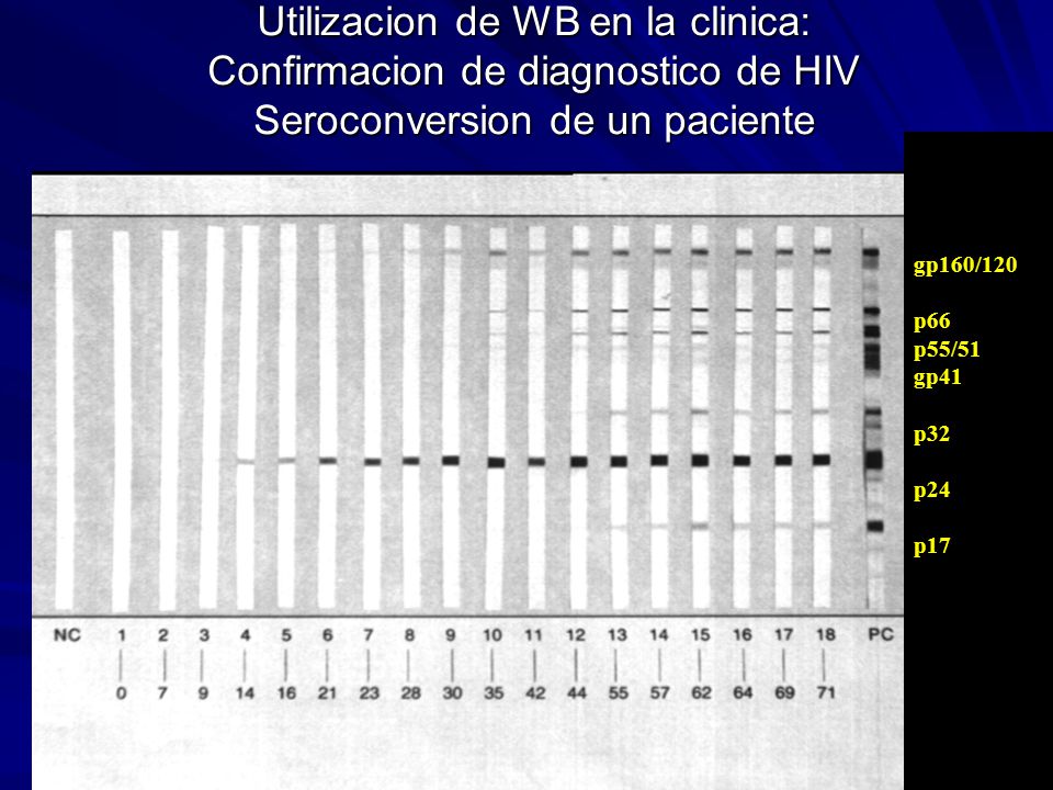 Utilizacion de WB en la clinica: Confirmacion de diagnostico de HIV Seroconversion de un paciente