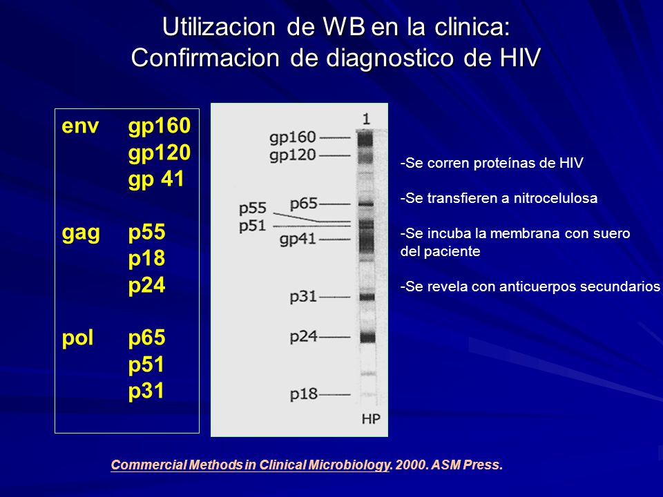 Utilizacion de WB en la clinica: Confirmacion de diagnostico de HIV