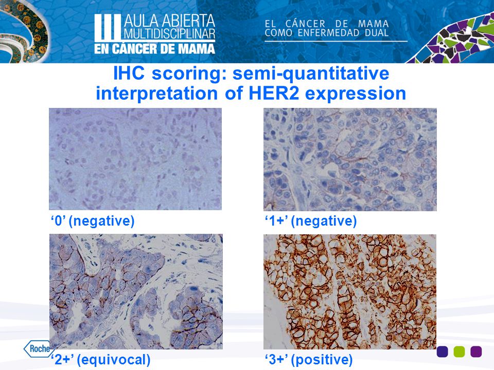 IHC scoring: semi-quantitative interpretation of HER2 expression
