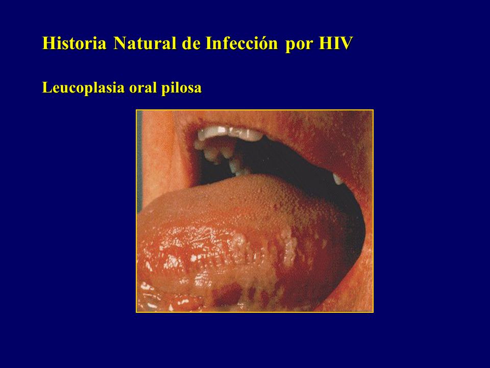Historia Natural de Infección por HIV Leucoplasia oral pilosa