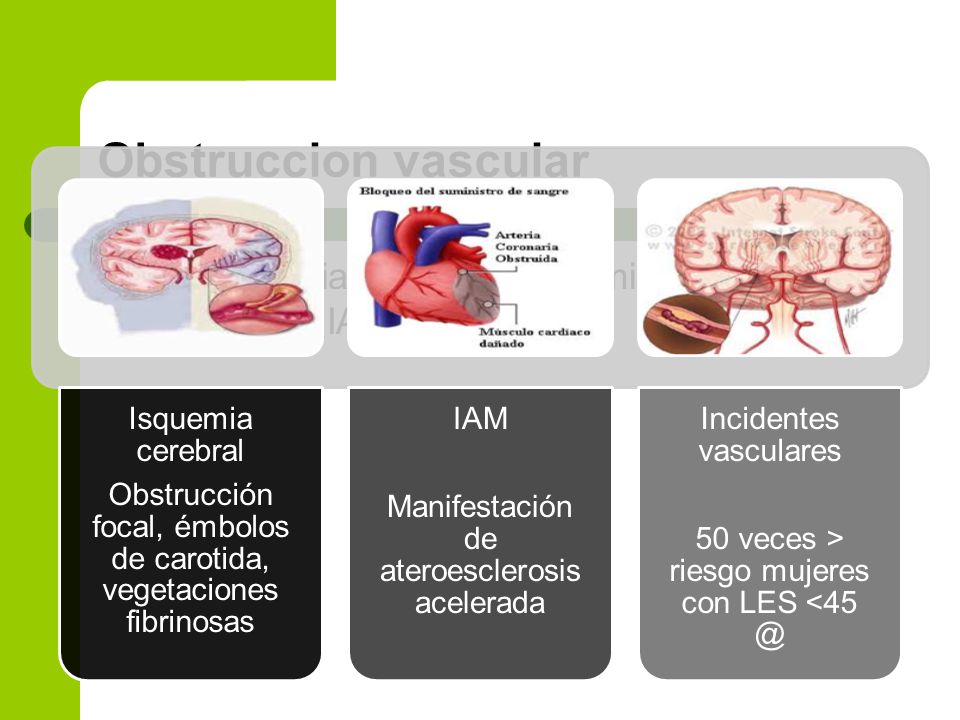 Obstruccion vascular Obstrucción focal, émbolos de carotida, vegetaciones fibrinosas. Isquemia cerebral.